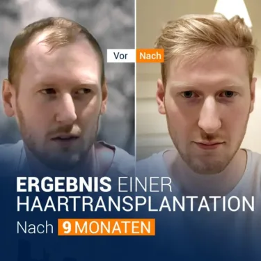 Hair Transplant
