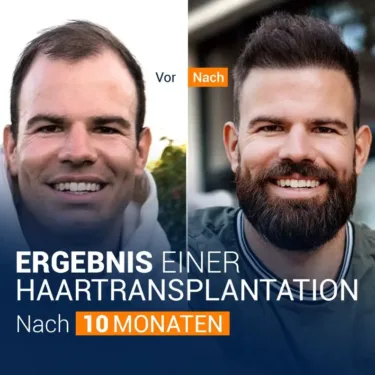 Пересадка бороды