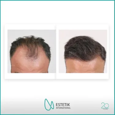 Hair Transplant