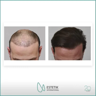 Hair Transplant