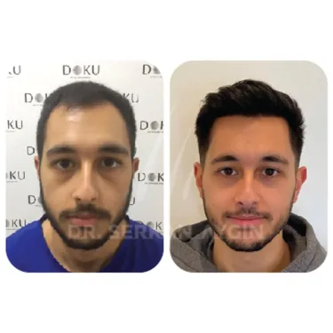 Hair Transplant