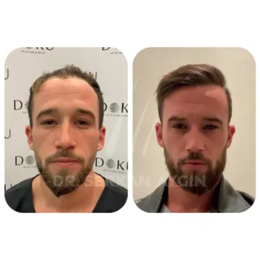 Hair Transplant