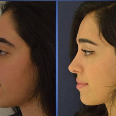 Ринопластика