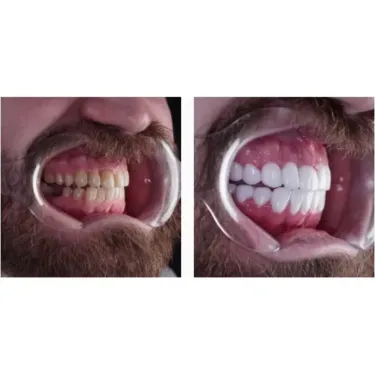 Зубные имплантаты