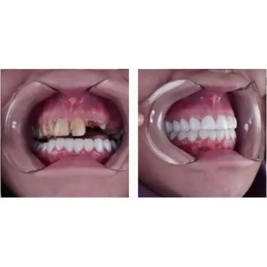 Зубные имплантаты