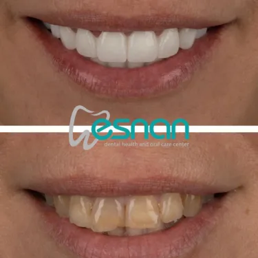 Hollywood smile (veneers)