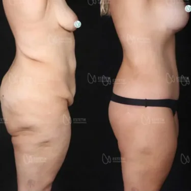 Липосакция