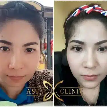 Blepharoplasty