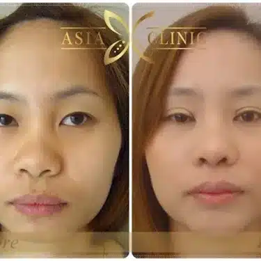 Blepharoplasty