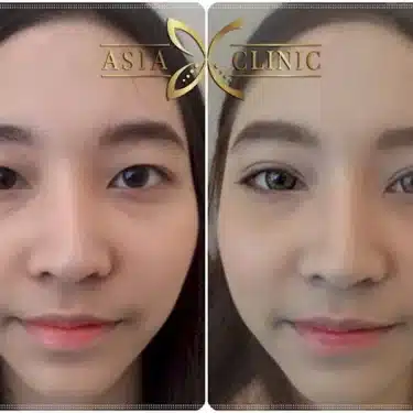 Blepharoplasty