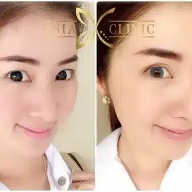 Blepharoplasty