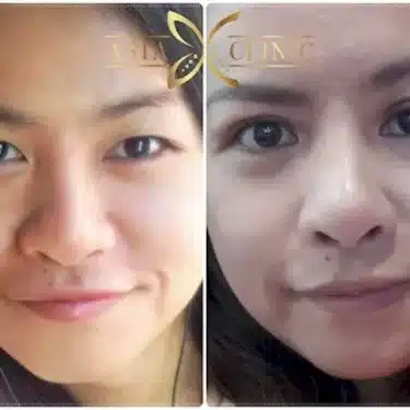 Blepharoplasty