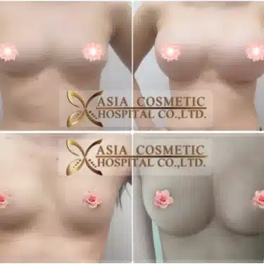 Breast augmentation