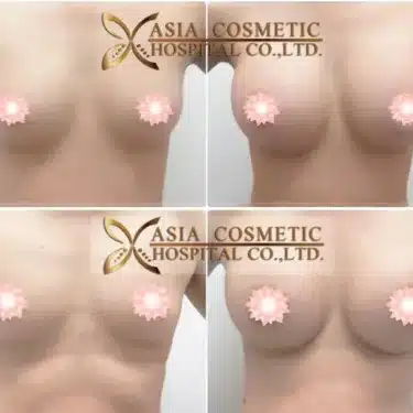 Breast augmentation