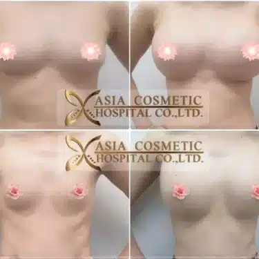 Breast augmentation