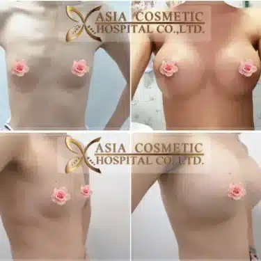 Breast augmentation