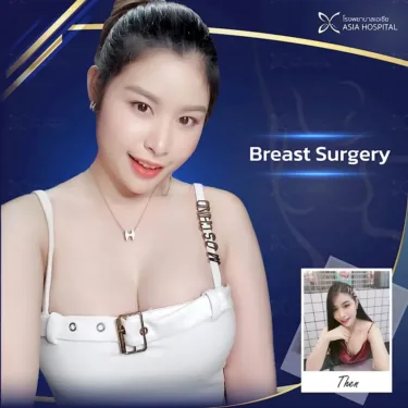 Breast augmentation
