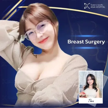 Breast augmentation