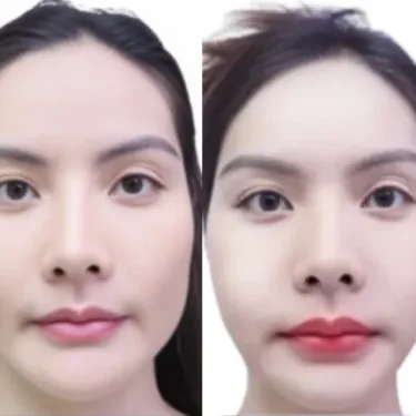Facial contouring
