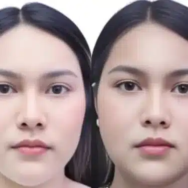 Facial contouring