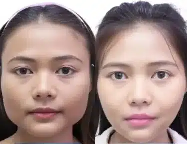 Facial contouring