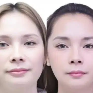 Facial contouring