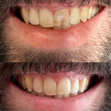 Dental restoration