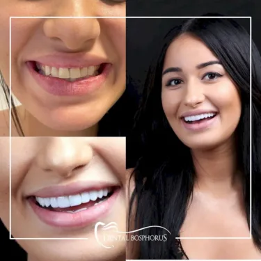Hollywood smile