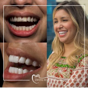 Hollywood smile