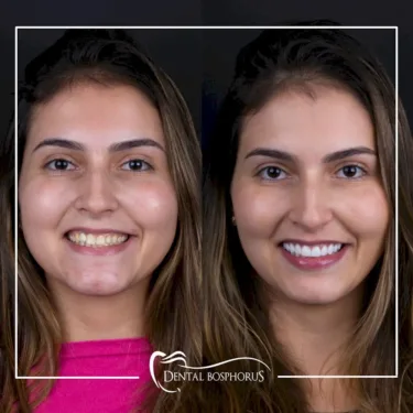 Hollywood smile