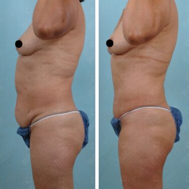 Liposuction 