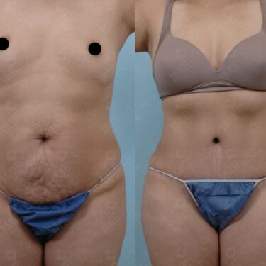 Liposuction 