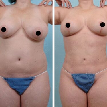 Liposuction 