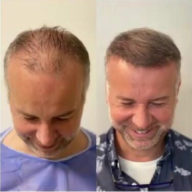 Hair transplant