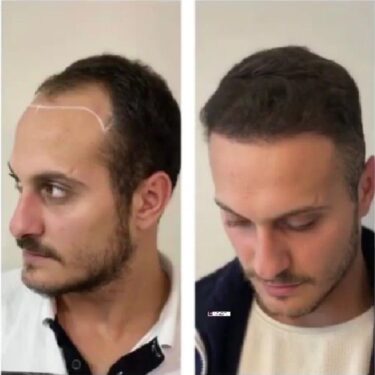 Hair transplant