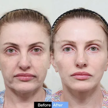 Face lifting