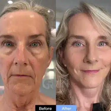 Face lifting