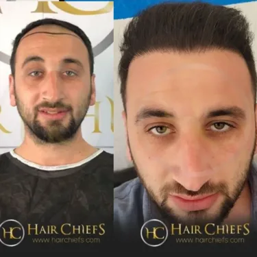 Hair transplantation