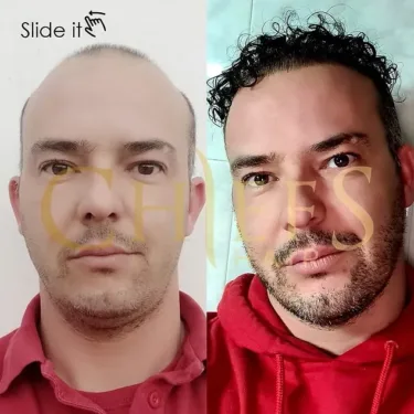 Hair transplantation