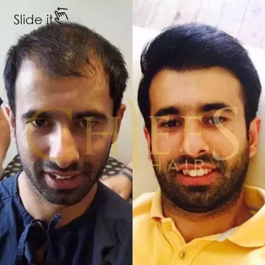 Hair transplantation