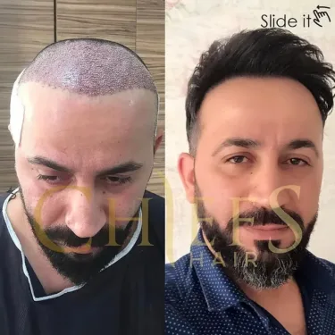 Трансплантація волосся