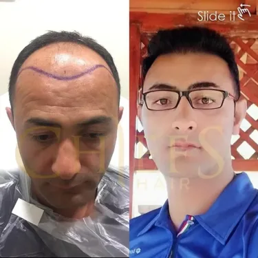 Hair transplantation