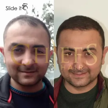 Hair transplantation