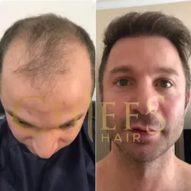 Hair transplantation