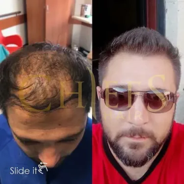 Hair transplantation