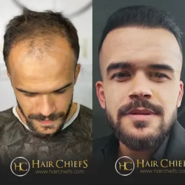 Hair transplantation