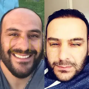 Hair transplantation