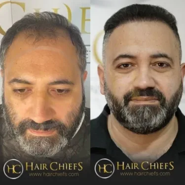 Hair transplantation