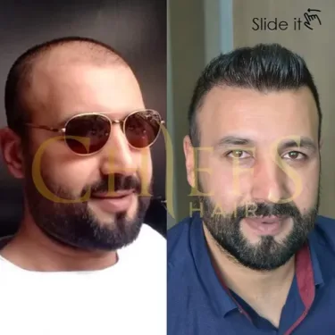 Hair transplantation