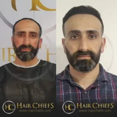 Hair transplantation